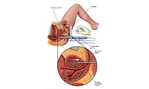 Best Prostate Cancer Treatment