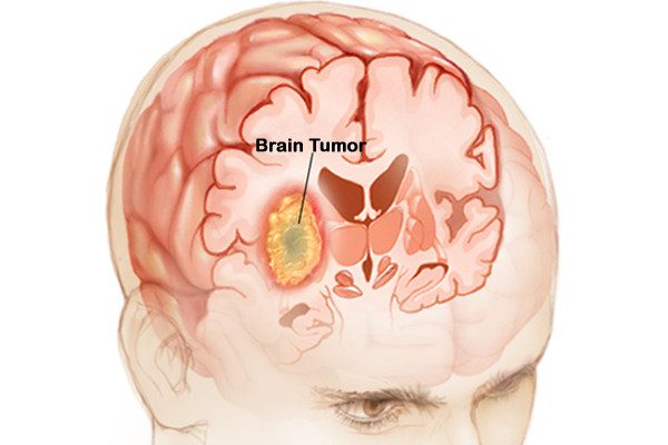 Brain Tumor treatment