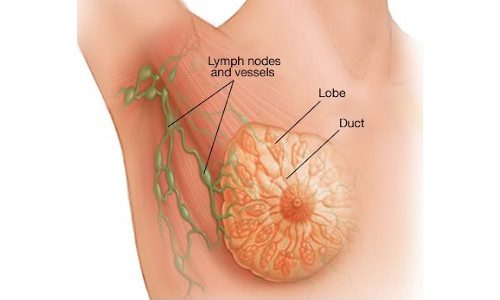 Breast Cancer treatment