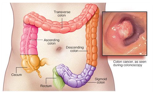 Colon Cancer treatment