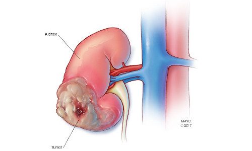 Kidney Cancer