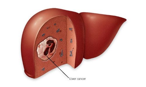 Liver Cancer