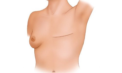 Breast Cancer treatment