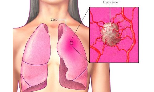 Lung Cancer