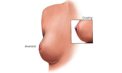 Breast Cancer treatment