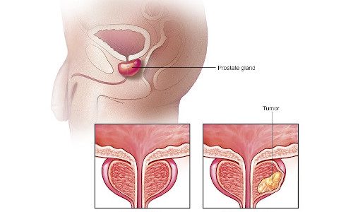 Prostate Cancer