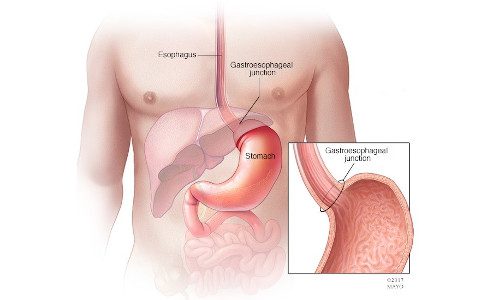 Stomach Cancer