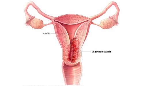 Uterus Cancer treatment