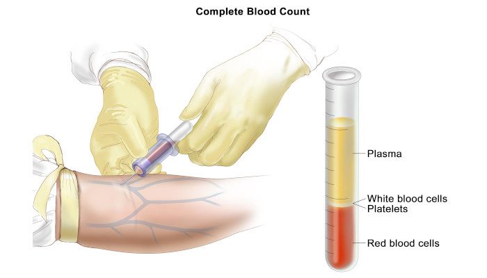 Treatments of Blood Cancer in Delhi 