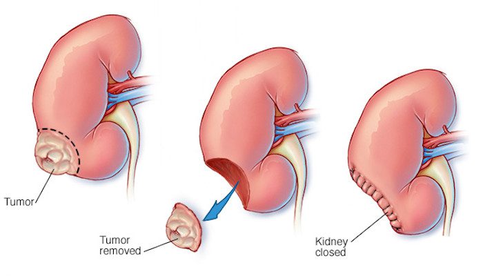 best cancer hospital in delhi