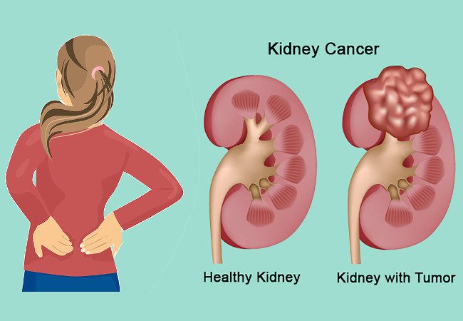 Kidney cancer treatment in Best cancer hospital in Delhi