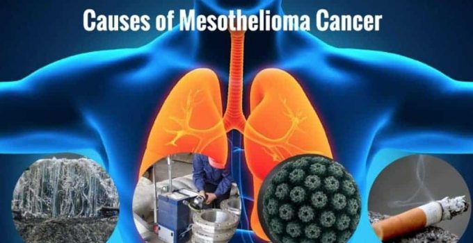 Mesothelioma Cancer Archives Oncoplus Hospital