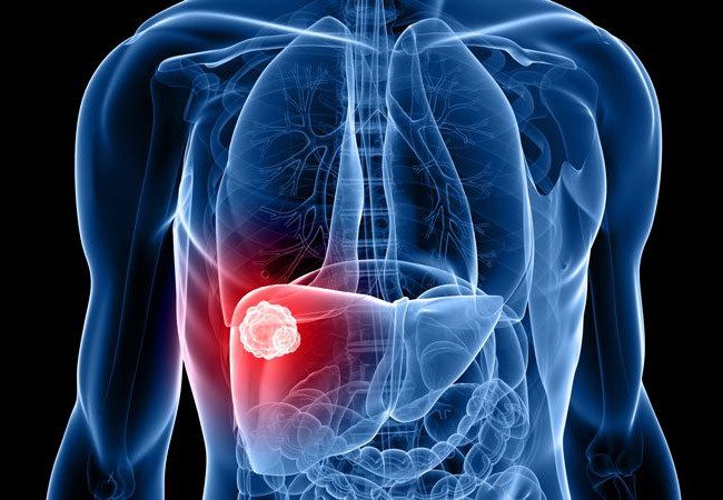 liver cancer