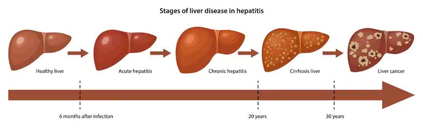 Diagnosis of liver cancer