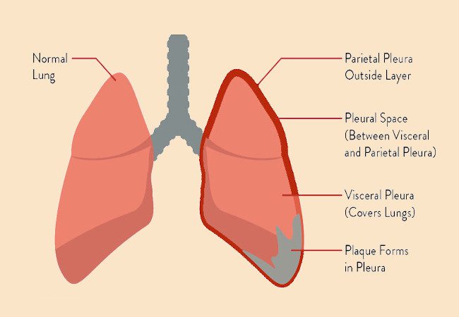 malignant mesothelioma of lung cancer