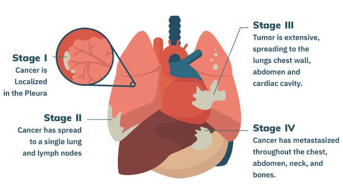 can you live a long time with stage 4 breast cancer