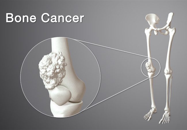 Everything about bone cancer from best cancer doctor in Delhi