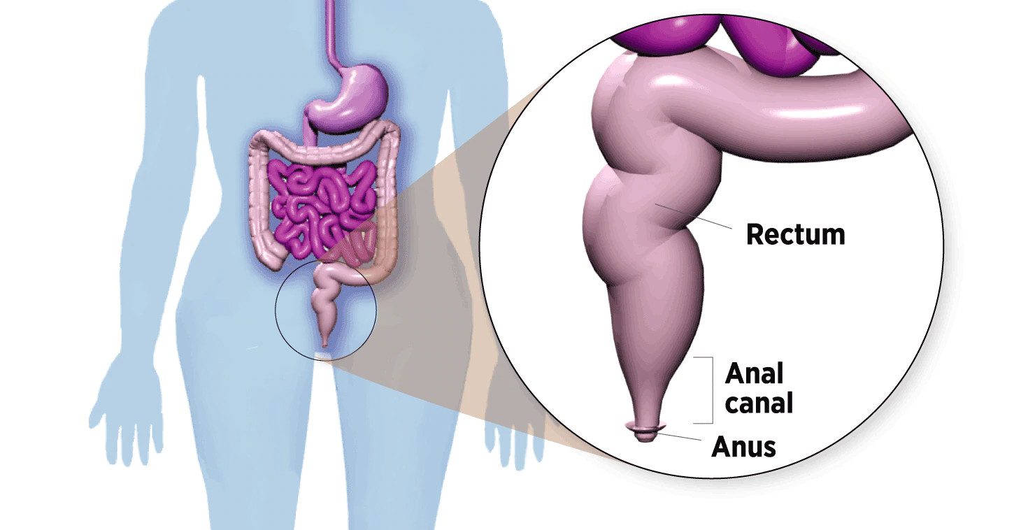 PREVENTION AND TREATMENT OF ANAL CANCER bilde