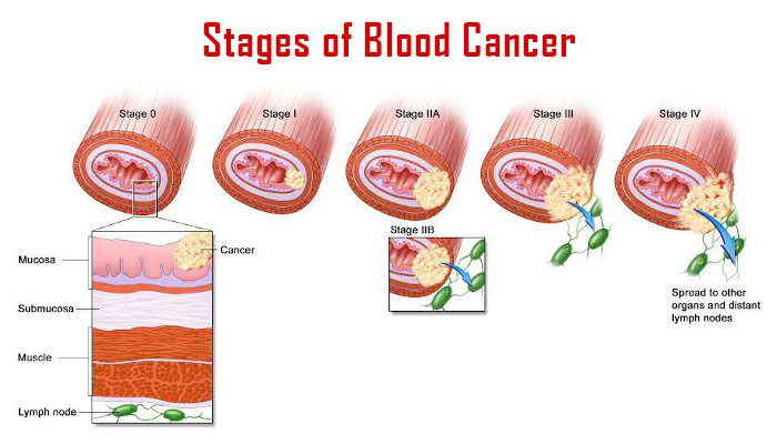 blood cancer