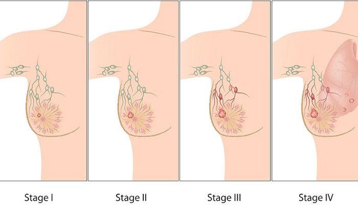 Cancer Treatment Delhi