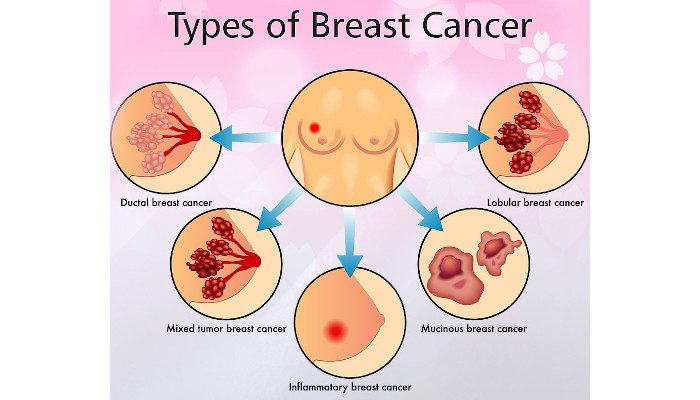 Breast Cancer 