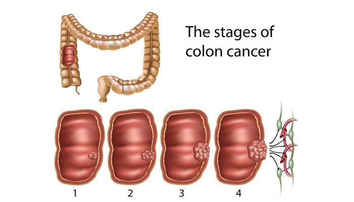 cancer specialist in delhi