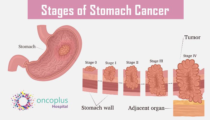 Stomach cancer