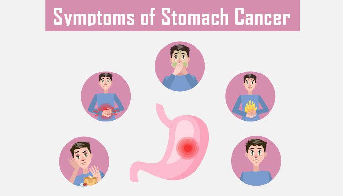 what are the symptoms of stomach cancer