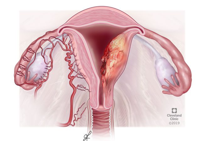 How Long Can You Survive Uterine Cancer Without Treatment