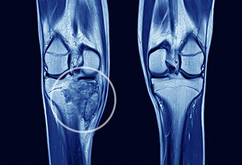 Understanding Bone Cancer: Symptoms, Treatments, and Prognosis for Adults