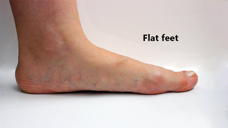 Flat Foot