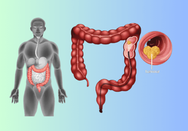 Six Ways to Lower Your Risk for Colorectal Cancer