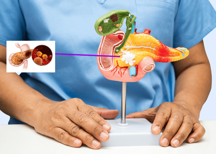 Early Signs of Pancreatic Cancer