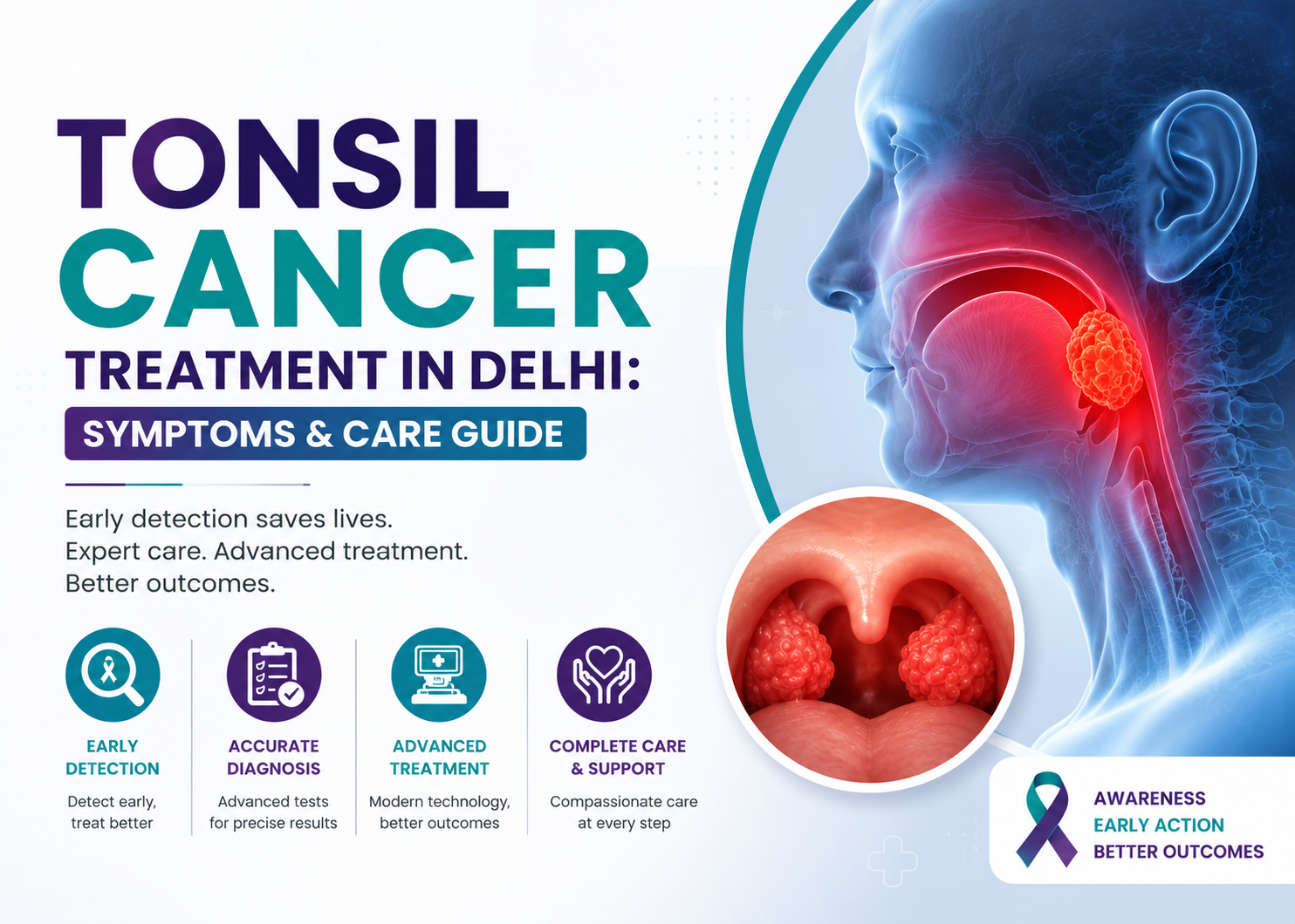 Tonsil Cancer Treatment in Delhi Symptoms & Care Guide